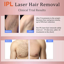 Load image into Gallery viewer, Permanent IPL Laser Hair Removal for Women/Men - BNM Health
