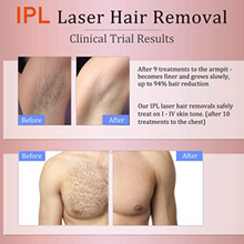 Load image into Gallery viewer, Permanent IPL Laser Hair Removal for Women/Men - BNM Health